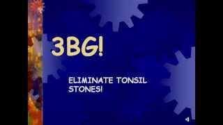 3BG ELIMINATE TONSIL STONES FAST [upl. by Lancey]