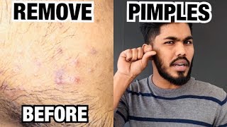 How to Remove Pimples Naturallyവെറുതെ കണ്ടതെല്ലാം തേച്ചു മുഖം കേടുവരുത്തരുത് [upl. by Rafiq]