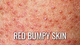 Keratosis Pilaris  How To Get Rid of Chicken Skin [upl. by Ubald]