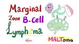 Marginal Zone BCell lymphoma MALToma  Indolent BCell NonHodgkin’s Lymphoma  Hematology Onco [upl. by Kama]