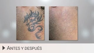 Eliminar tatuajes con láser  Antes y después [upl. by Bannon]