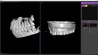 1 Implastation Import DICOM and STL alignment [upl. by Aibar]