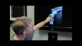 TPLO surgery discussed by Michael Bauer DVM DACVS [upl. by Crandell]