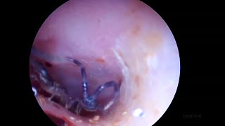 Centipede Caught Inside A Human Ear ON VIDEO [upl. by Nohtanoj296]