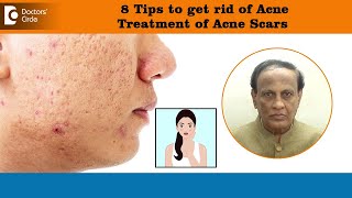 8 Tips to get rid of ACNE SCARS  Best Treatment for Deep Acne Pits  DrD A Satish Doctors Circle [upl. by Emmer]