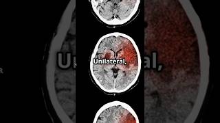 SturgeWeber Syndrome Mnemonic medicalstudent medicaleducation usmlepreparation DiagnosticLens [upl. by Bander]