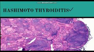 Hashimotos Thyroiditis  PathogenesisMorphology amp Clinical features [upl. by Itnuahsa]