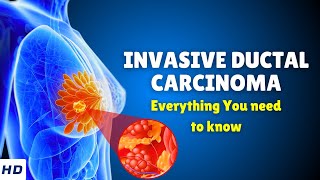 Invasive Ductal Carcinoma Breast Cancer – Causes Signs and Symptoms Diagnosis amp Treatment [upl. by Clorinde]