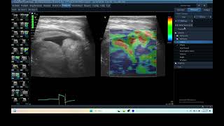 IQ 290 TFAST LUNG MASS ULTRASOUND ICP CPP ECHOPAC ANALYSIS ELASTOGRAPHY 3 [upl. by Kcod]