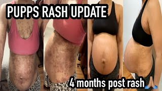 UPDATE PREGNANCY RASH  PUPPS RASH [upl. by Publea]