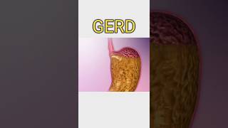 GERDmedicine healthtips healthcaresymptoms treatmentdoctorgerdgerdtreatment gerdanxiety [upl. by Nollid]