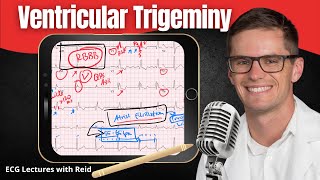 Ventricular Trigeminy EKG  ECG Lecture [upl. by Akinej]