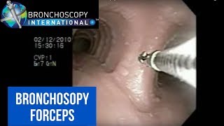 Flexible Bronchoscopy Basic Techniques for Forceps Biopsy [upl. by Ynalem]