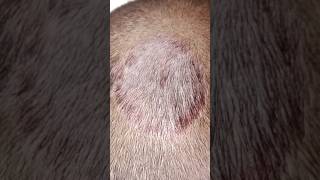 Example of tinea capitis  tinea tineacapitis medical fungalinfection shorts [upl. by Aillij]