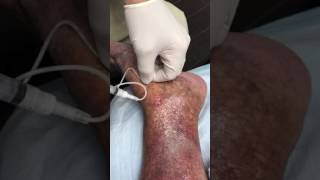 Rapid Healing of Venous Ulcers After Foam Sclerotherapy Treatment [upl. by Crenshaw]