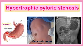 hypertrophic pyloric stenosis [upl. by Naujek647]