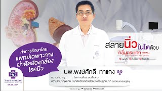 สลายนิ่วด้วยคลื่นกระแทก ESWL Extracorporeal Shock Wave Lithotripsy [upl. by Aronson]