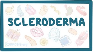 Scleroderma  an Osmosis Preview [upl. by Vihs778]