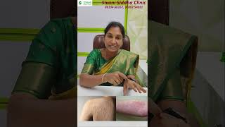 Urticaria  DrA Anitha Yugeshwaran BSMS  SIVANI SIDDHA  urticaria dranitha siddha [upl. by Aicirt]