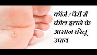 Corn ka ilaj in hindi Corn Removal Home Remedies Corn Home Treatment Corn ka Gharelu Ilaj Gokhru [upl. by Nnairak]