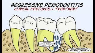 Aggressive Periodontitis Part 2  Clinical features and treatment [upl. by Etteiluj]