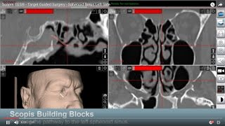 Scopis TGS®  TargetGuided Surgery  Sphenoid Sinus Left Side [upl. by Dolphin]