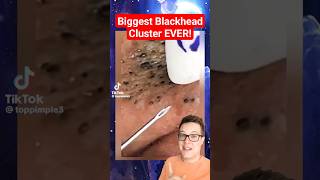 BIGGEST BLACKHEADS REMOVAL EVER  Extreme Blackheads on Cheek shorts [upl. by Bianca]