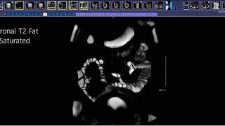 How to read an MR Enterography [upl. by Nollahp]