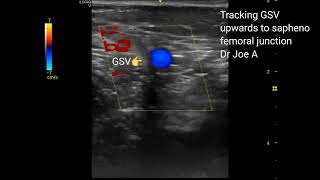 Tracking the great saphenous vein to the saphenofemoral junction Color Doppler ultrasound video [upl. by Peih236]