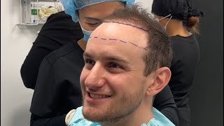 How to decide your Hair Transplant hairline height PT2￼ [upl. by Cirtap339]