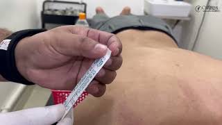 Dry Needling Treatment for Deviated Neck  Effective Neck Pain Treatment in Kolkata [upl. by Sidras]