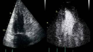 CONTRAST ECHO CARDIOMYOPATHIE TRABECULATION OU NON [upl. by Isidro]