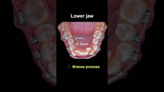 The whole process of orthodontics dentist dentistry dentista tooth treatment dentaltechnique [upl. by Alohs748]