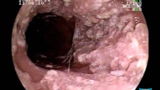 Endoscopic Imaging of Esophageal Verrucous Carcinoma [upl. by Free]