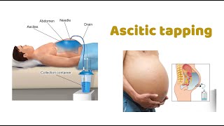 Ascitic Tap  StepbyStep Guide  How to do Ascitic tap  Pigtail Drainage  Peritoneal Tapping [upl. by Harima519]