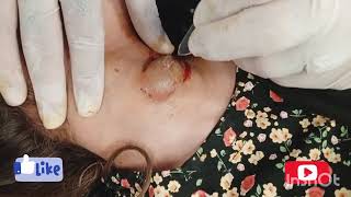 Neck Abscess Drainage 😱🫣😳تخلیه آبسی گردن subscribe explore tiktok tiktok doctor india doctor [upl. by Relyuc110]