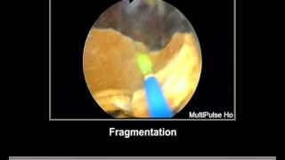 Bladder Stone Holmium Laser [upl. by Ingar]