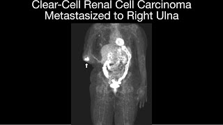 ClearCell Metastatic Renal Cell Carcinoma to Ulna [upl. by Airdnaz553]