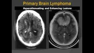 Corpus Callosum Primary CNS Lymphoma PCNSL RadiologicPathologic Correlation [upl. by Naesed]