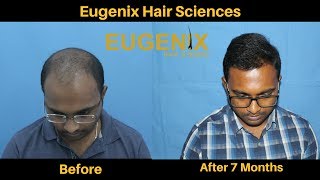 Hair Transplant Clinic in Bhubaneswar Odisha  Hair Transplant Surgeon  Eugenix [upl. by Llennhoj142]