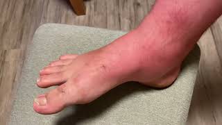 Why is my foot and leg extremely swollen what to do after a black fly bite [upl. by Kathye190]