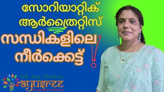 സോറിയാറ്റിക് ആർത്രൈറ്റിസ്സന്ധികളിലെ നീർക്കെട്ട്വേദനഅറിയാംDrSreela Ayursree Ayurveda Hospital [upl. by Giuliana]