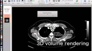 OsiriXsimulated Navigation S1lung segmentectomy [upl. by Anilorak]