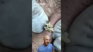 You aren’t ready for this cyst and ingrown hair combo👊💥 credit brufoilpimple doctorsatisfying [upl. by Delphina]