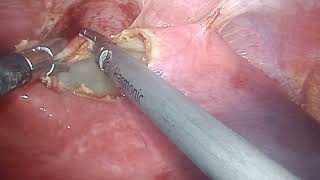 hydatid cyst surgery at Bombay hospital Indore [upl. by Enelav]