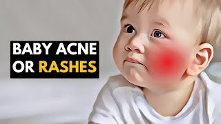 Gentle Care for Little Faces Managing Baby Acne and Rashes [upl. by Atteynad]