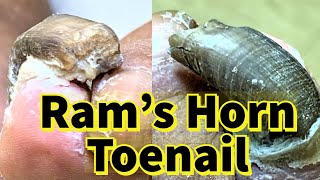 Rams Horn Toenail Severe Fungal Toenail [upl. by Enirok]