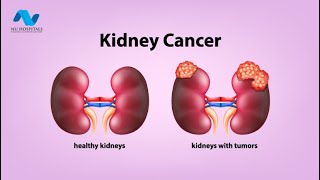 Pathology of Renal Neoplasia Pathoma Lectures word by word explained [upl. by Ashil]