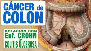 Cáncer de Colon y Enfermedad Inflamatoria Intestinal [upl. by Zsa Zsa]