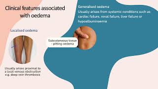 Clinical presentation of oedema [upl. by Nylrad]